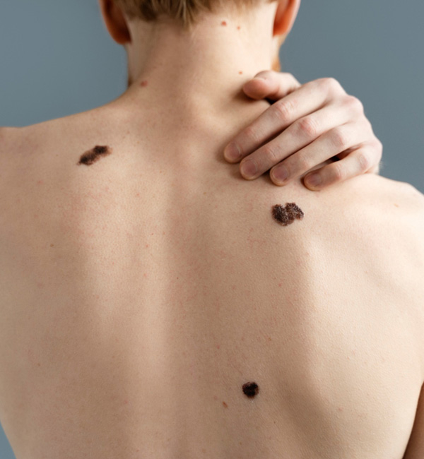 When to See a Melanoma Specialist