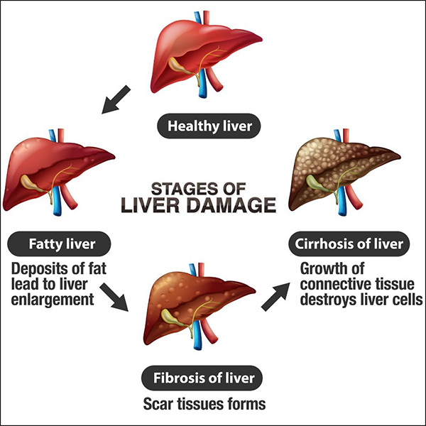 Types of Colorectal Cancer