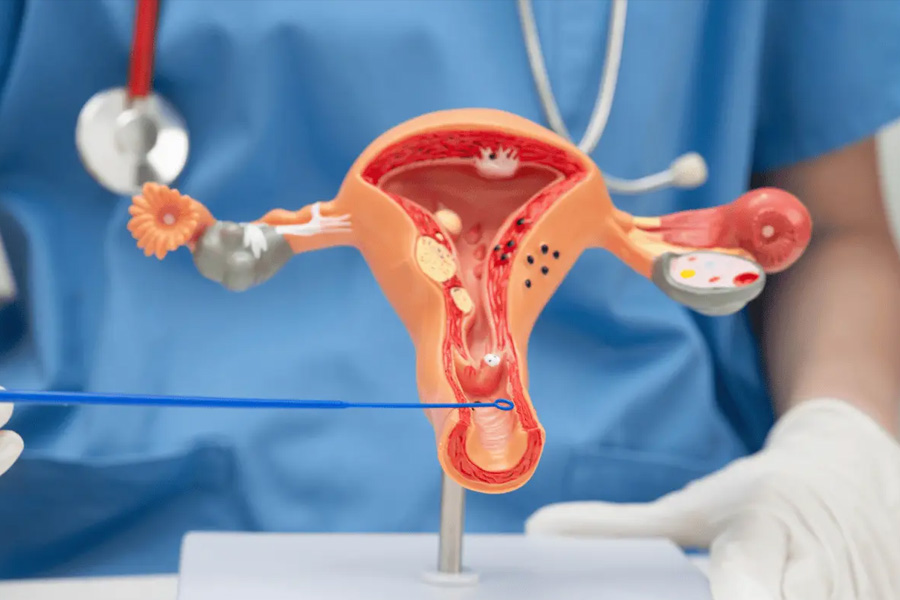 Cervix Cancer Consultation